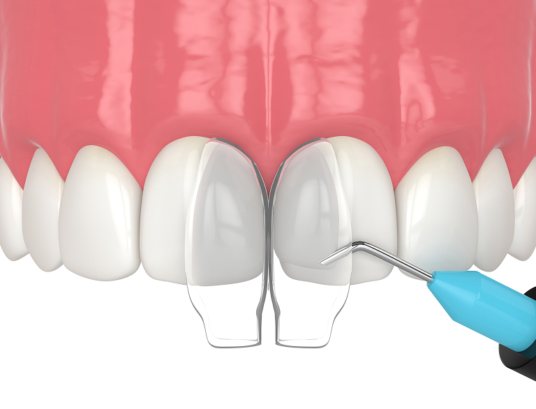 Why Dental Bonding Matters