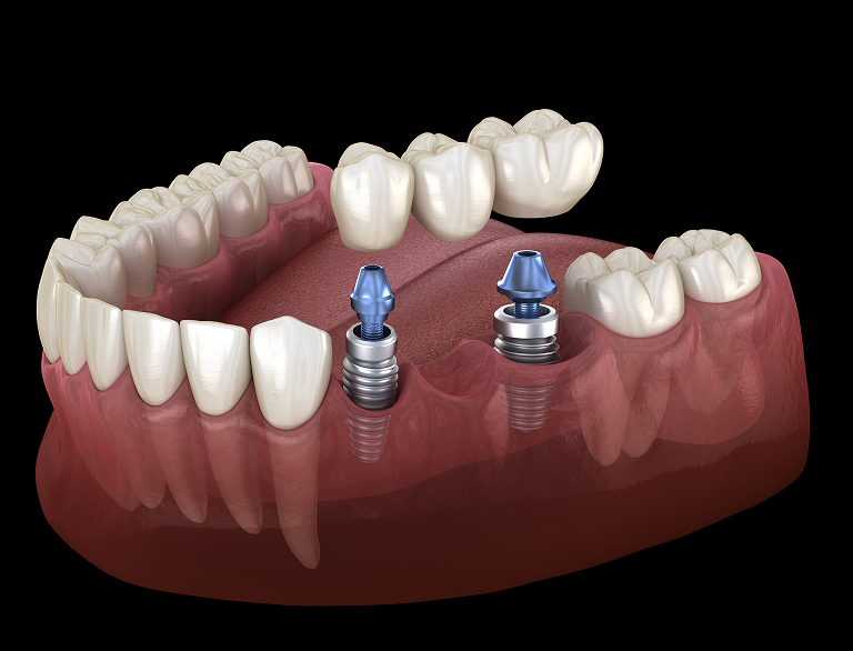 Benefits of Dental Bridges
