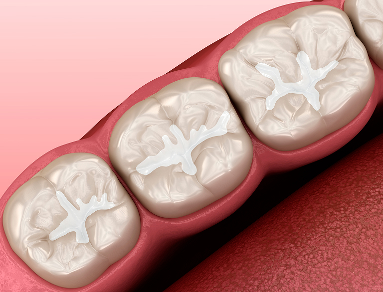 Why Dental Fillings Are Important