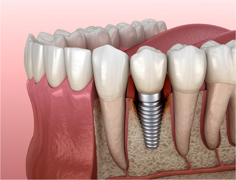 The Modern Solution for Missing Teeth