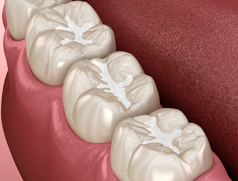 Why Dental Sealants Matter