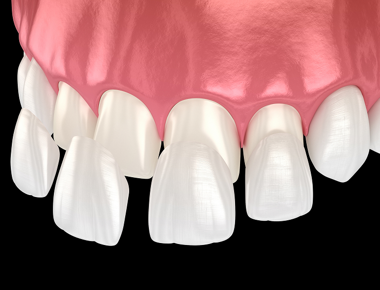 Why Veneers Are a Popular Choice