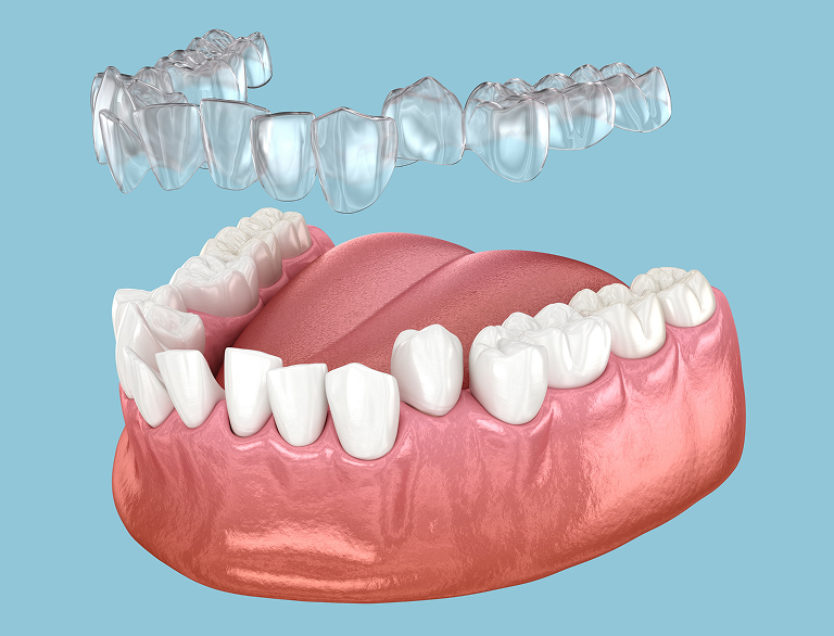 Why Invisalign Matters